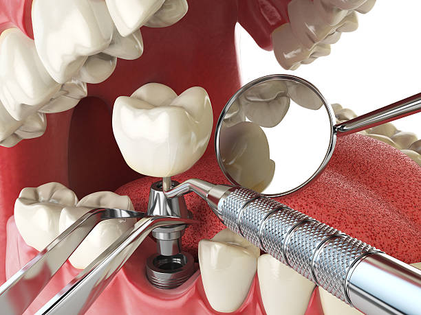Best Emergency Broken Tooth Repair in Kensington Park, FL